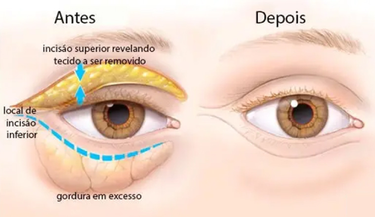 antes-dps-4